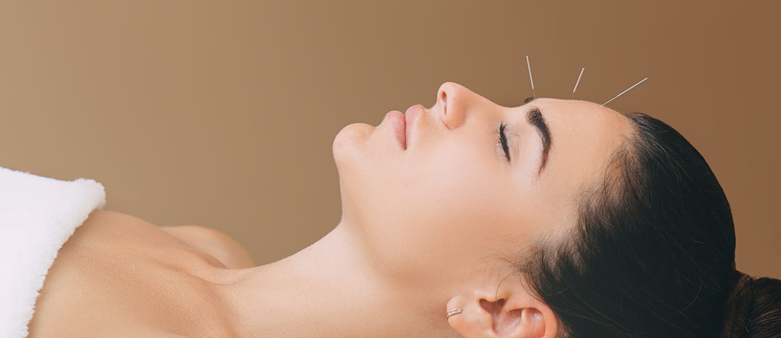 acupuncture treatments for headaches and migraines